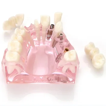 M2008 Dinte Dentare Model de Implant Modelul cu Punte Ceramica Coroana și Implant Pod